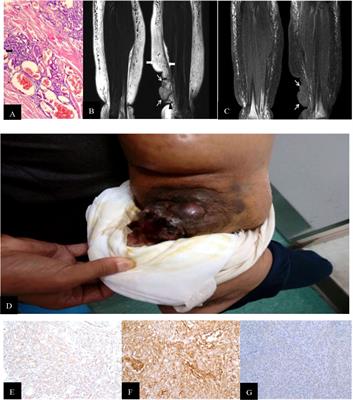 Magnetic resonance findings of Stewart–Treves Syndrome in primary limb lymphedema compared with pathology: A retrospective single-center study